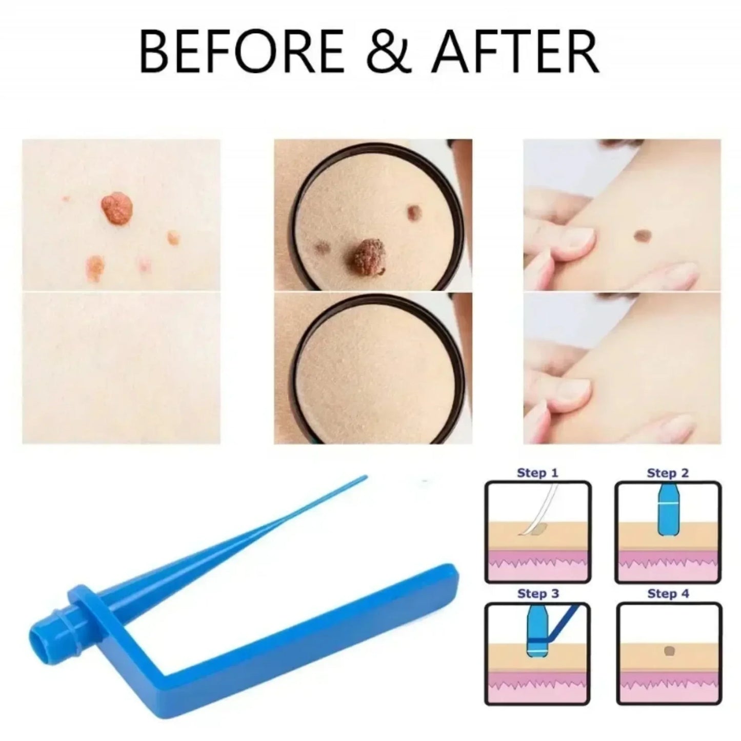 Skin Tag Removal Kit Skin Mole Wart Remover Micro Face Care Treatment Tools Set with Cleansing Swabs Beauty & Health Skincare