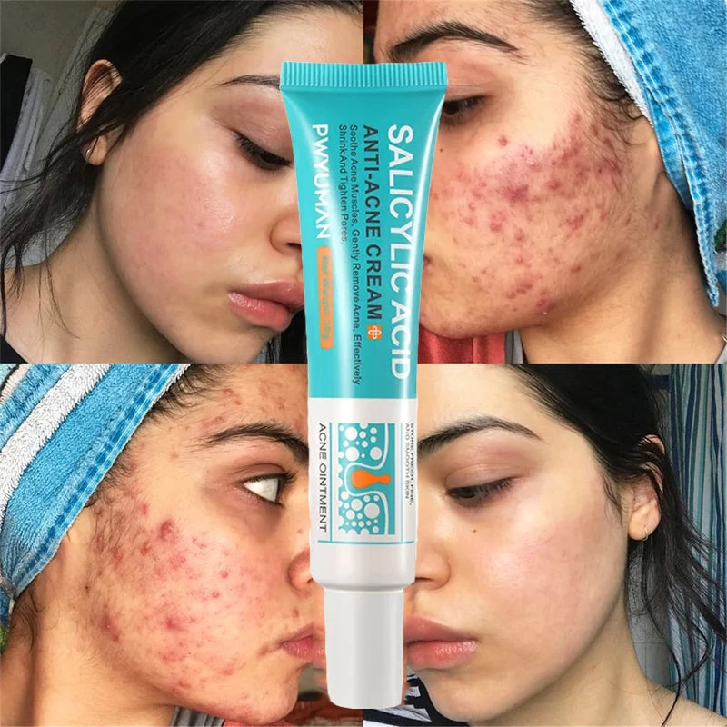 Salicylic Acid Acne Removal Cream Anti-Acne Repair Redness Pimple Spots Deep Cleaning Pore Oil Control Moisturizing Skin Care