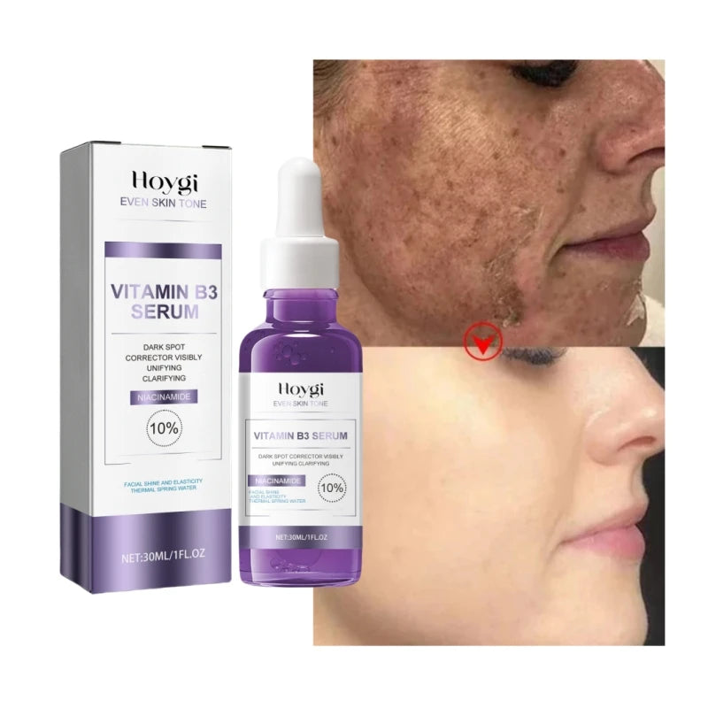 Dark Spots Remover Whitening Serum Face Freckle Melanin Correcting Anti Pigmentation Brighten Beauty Korean Day Night Skin Care