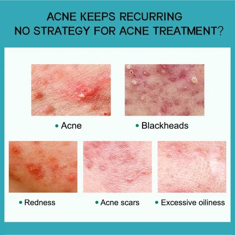 Salicylic Acid Acne Removal Cream Anti-Acne Repair Redness Pimple Spots Deep Cleaning Pore Oil Control Moisturizing Skin Care