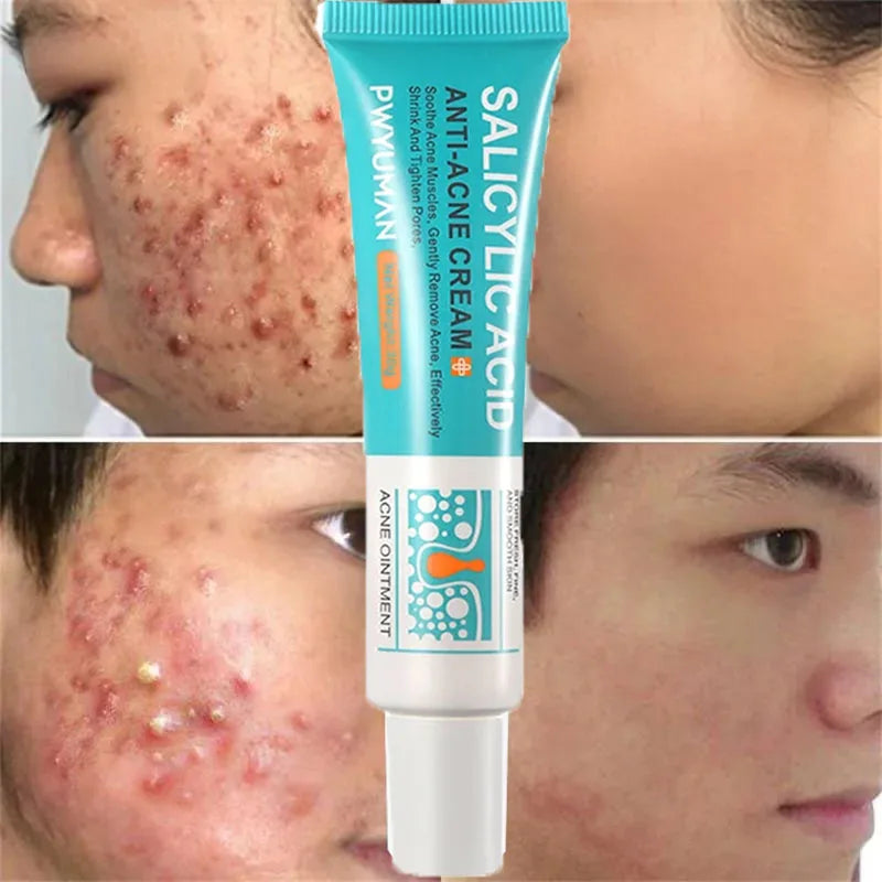 Salicylic Acid Acne Removal Cream Anti-Acne Repair Redness Pimple Spots Deep Cleaning Pore Oil Control Moisturizing Skin Care